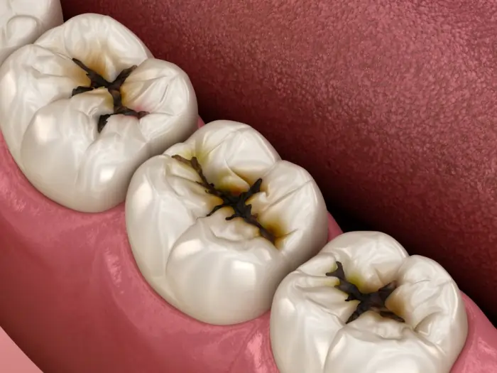 Close-up illustration of dental cavities and dark decay forming in the deep pits and fissures of white molar teeth surfaces along the gum line.