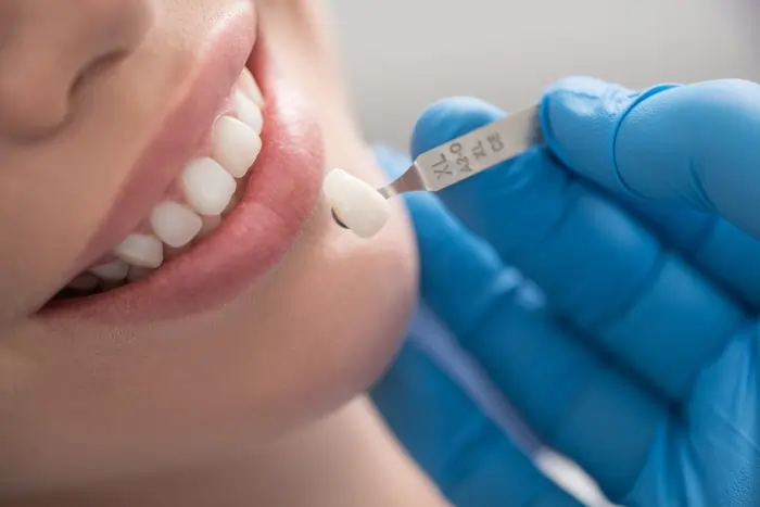 A dentist matching a porcelain tooth shade to a patient's smile during a procedure for dental crowns to treat moderate to severe decay.