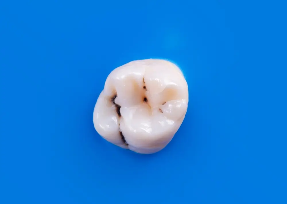 Close-up of a molar tooth showing small dark decay spots illustrating what an early stage cavity actually looks like.