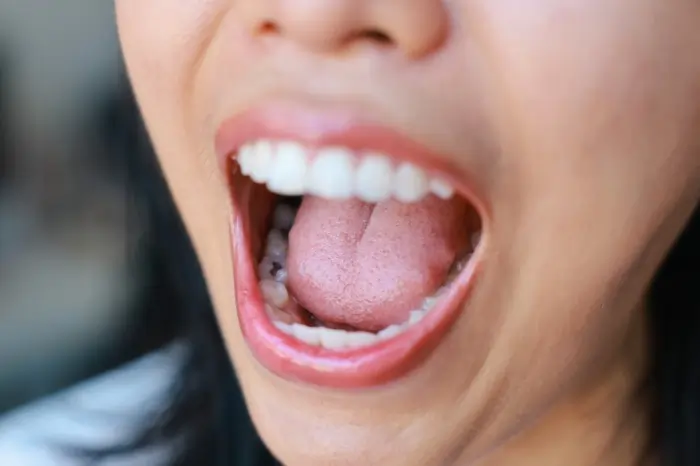 Close-up of a patient's open mouth showing visible signs of tooth decay on the molars, illustrating the symptoms and early stages of a cavity.