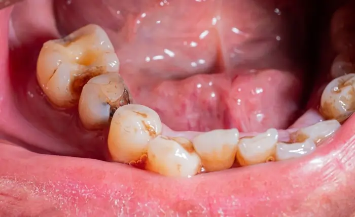 Severe bacterial infection and plaque buildup on molars, showing what causes tooth decay and advanced cavity formation.