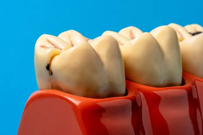 early tooth decay cavity on molar showing why prevention matters dental health concept for preventing tooth decay